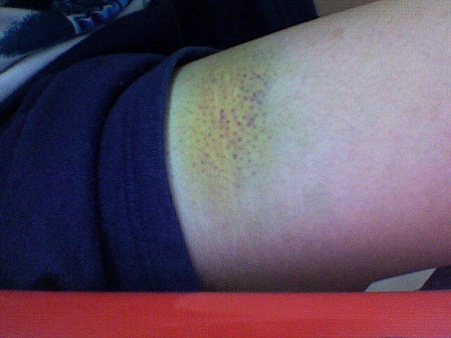 yellow bruise on leg