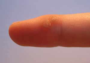 finger wart